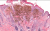 Screenshot_2021-04-13 melanoma_of_the_skin__2_ jpg (immagine JPEG, 500 × 273 pixel)