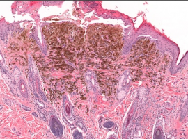 Screenshot_2021-04-13 melanoma_of_the_skin__2_ jpg (immagine JPEG, 500 × 273 pixel)