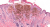 Screenshot_2021-04-13 melanoma_of_the_skin__2_ jpg (immagine JPEG, 500 × 273 pixel)