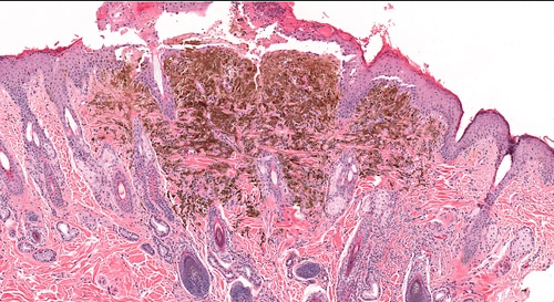 Screenshot_2021-04-13 melanoma_of_the_skin__2_ jpg (immagine JPEG, 500 × 273 pixel)